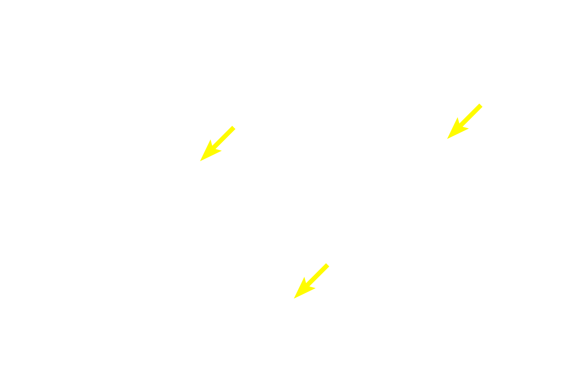  - Nuclei <p>Several pseudounipolar neurons are seen in this image.  Pseudounipolar neuron cell bodies vary in size, a feature that correlates with the type of sensory information each neuron conveys.  Each cell body is surrounded by satellite Schwann cells which form a capsule.  750x</p>
