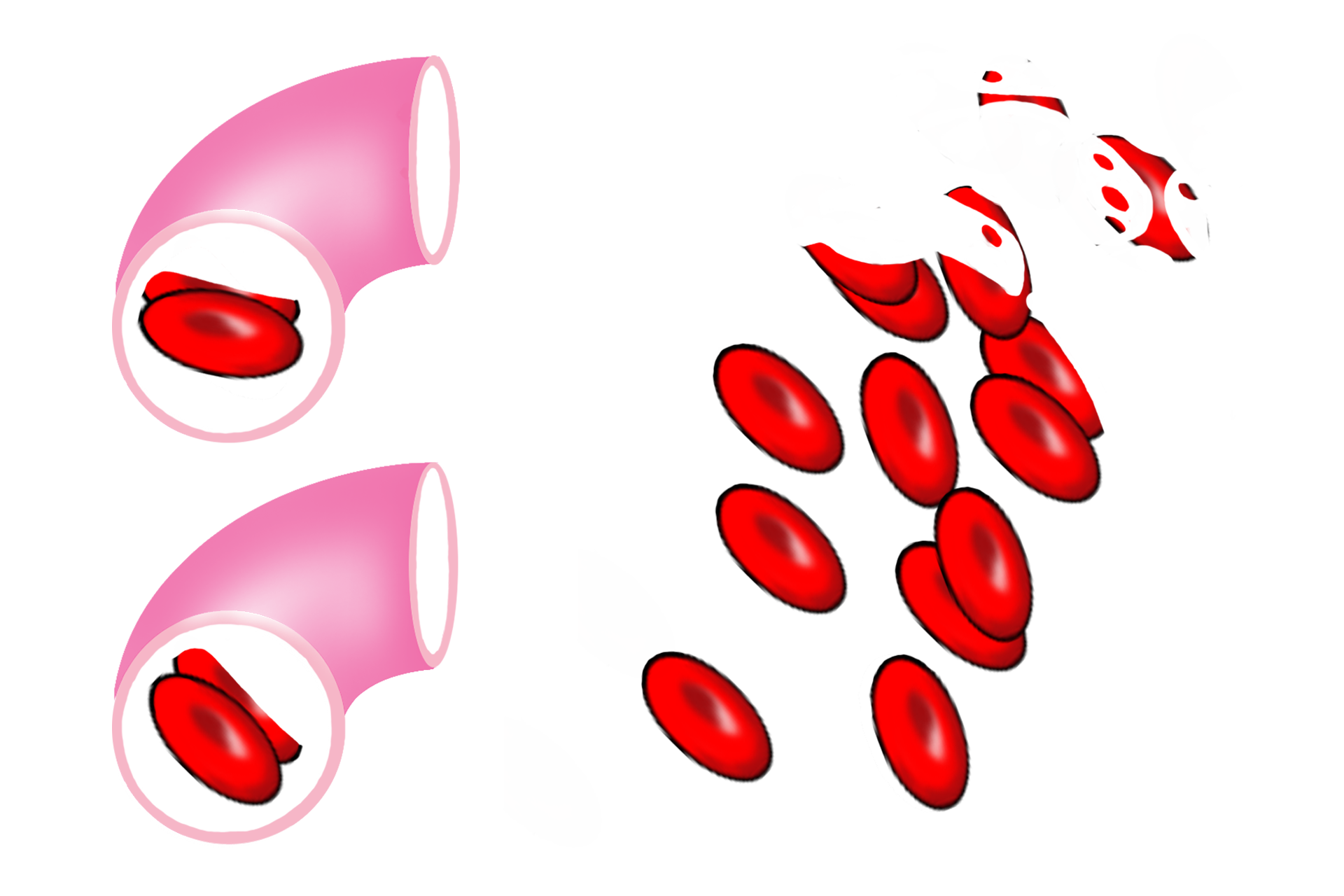 Red blood cells > <p>Continuous and fenestrated capillaries are so narrow that red blood cells flow through them in single file. Discontinuous capillaries have much wider lumens, allowing multiple cells to flow through simultaneously. They also transport blood at a slower rate than do smaller diameter capillaries.</p>
