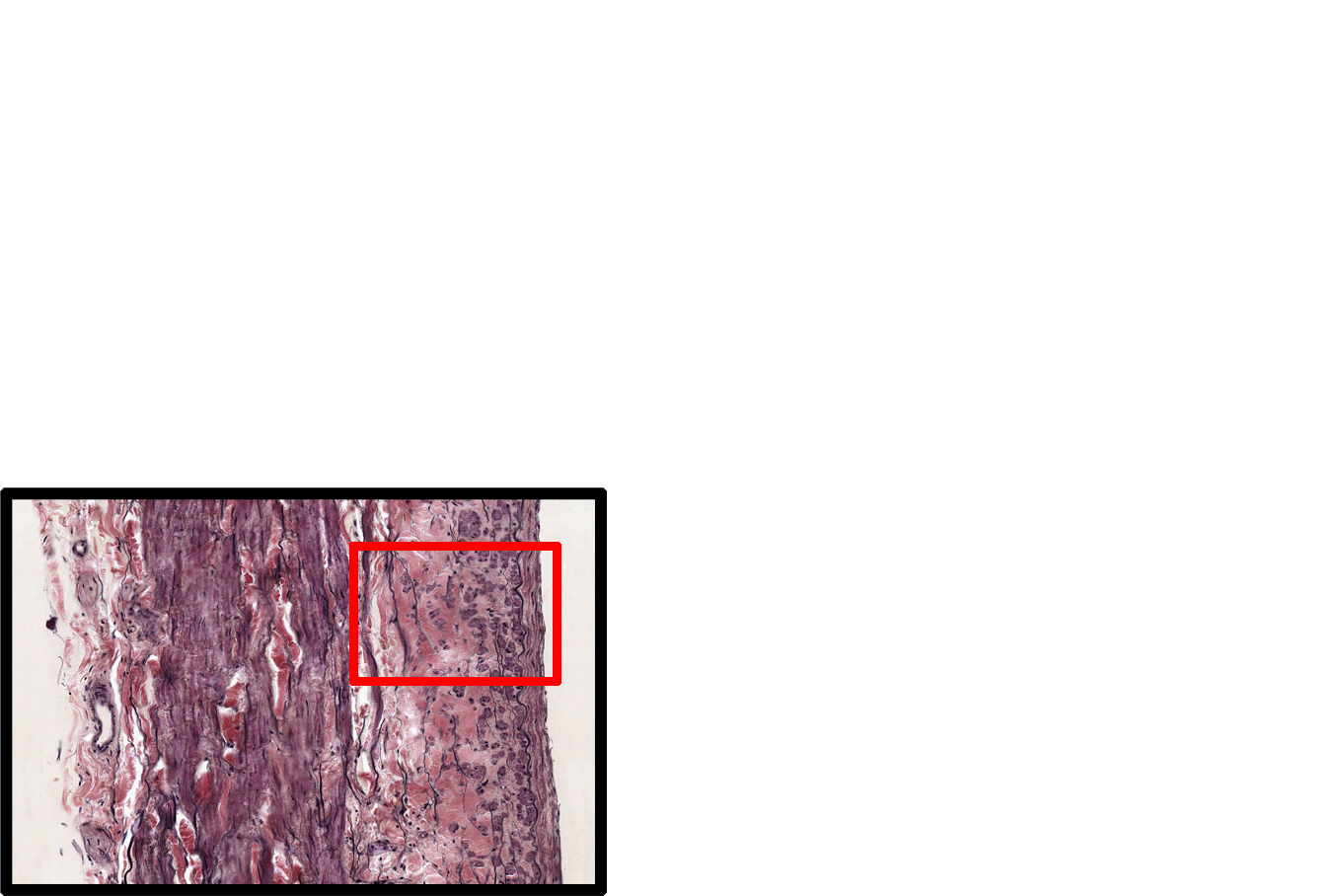Location of the image <p>The walls of large veins show great heterogeneity.  Here, tunica intima is composed of endothelium and a CT layer that contains longitudinally orientated smooth muscle.  A discontinuous internal elastic lamina is present.  Tunica media is composed of circularly arranged smooth muscle (cut in cross section in this longitudinal section), interspersed with CT.  400x</p>

