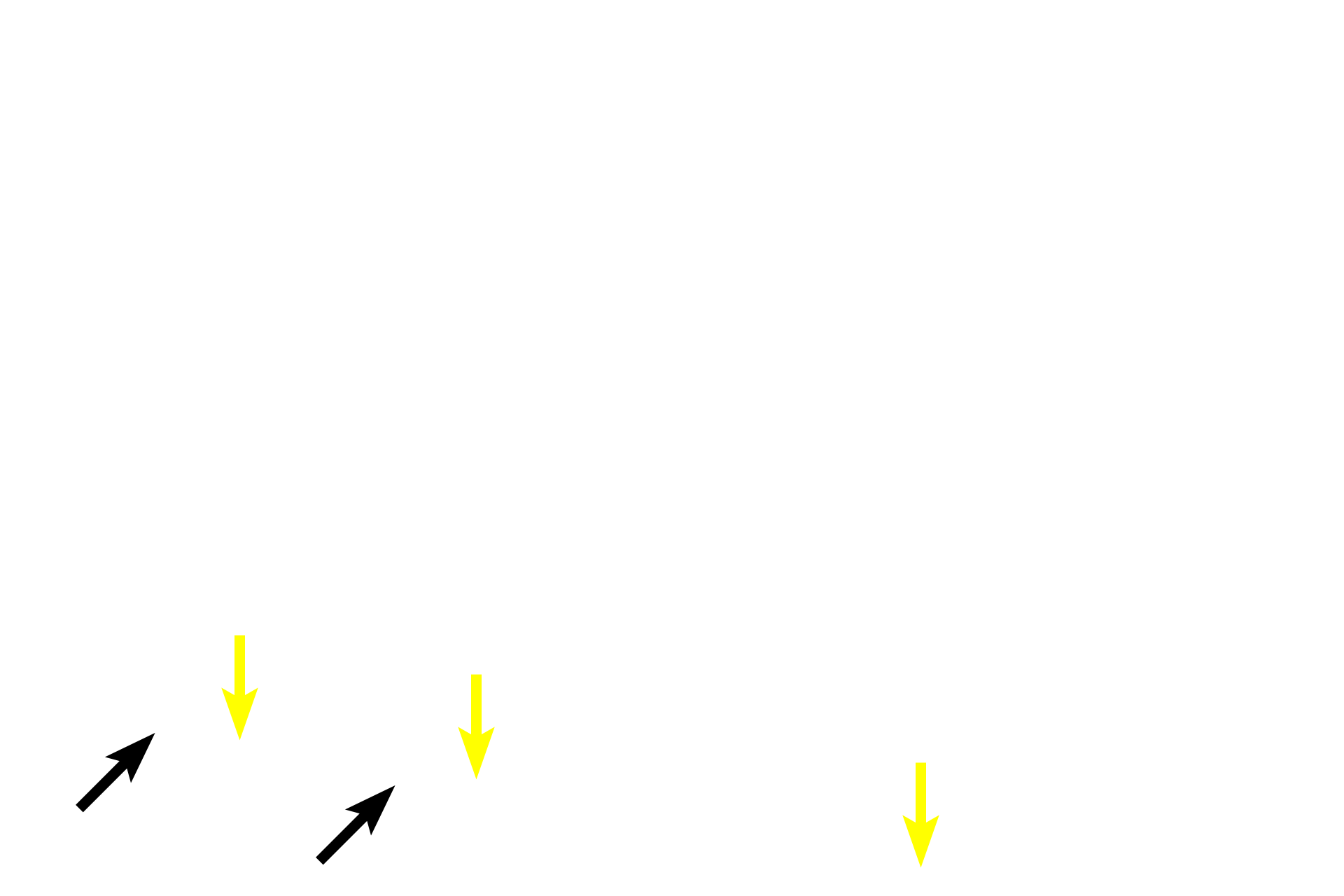 Serosa > <p>The outermost layer of the large intestine is either an adventitia or a serosa, depending on whether a particular segment of this organ is intra- or retroperitoneal in location.  The segment in this section is intraperitoneal and thus shows a serosa with connective tissue layer (yellow arrows) and mesothelium consisting of simple squamous epithelium.  This serosa is also called the visceral peritoneum.</p>
