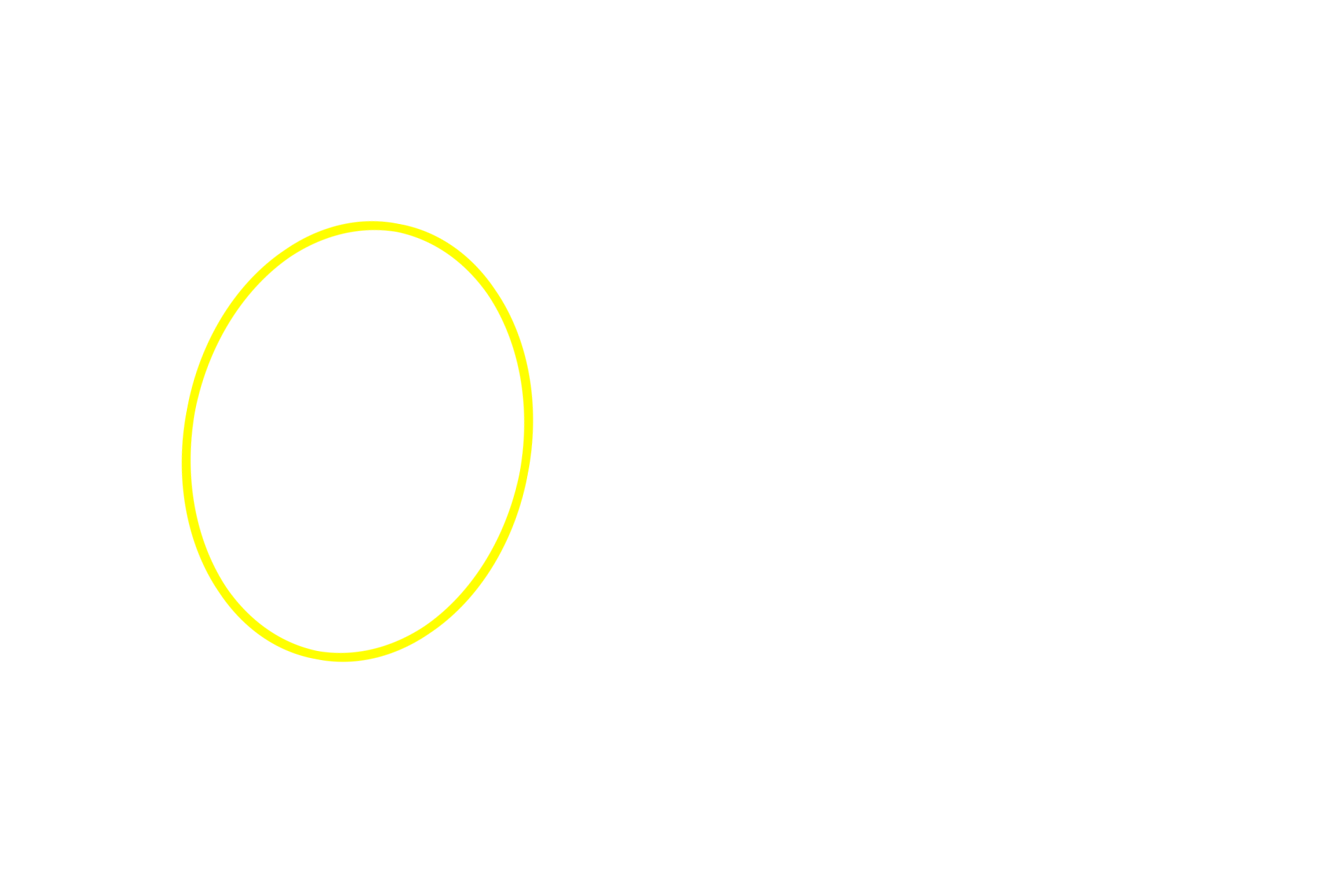 Lymphoid nodule <p>The central arteriole and its relationship to the PALS is seen at higher magnification (area indicated by the yellow frame in the inset).  For most of its course, the central arteriole is surrounded by PALS.  Frequently, lymphoid nodules, B-dependent areas that form part of white pulp, develop within the PALS, causing the central arteriole to be eccentrically located.  A germinal center is just beginning to form.  200x</p>
