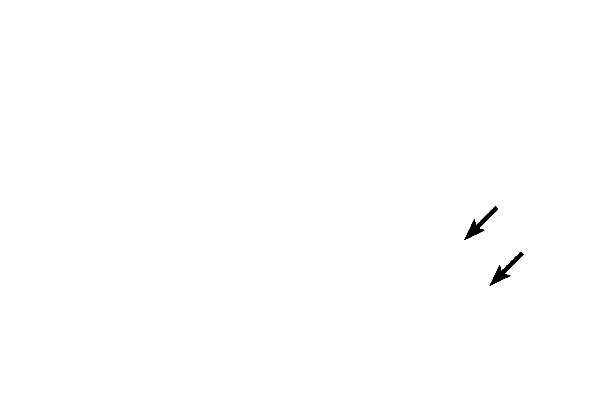 Optic nerve <p>Axons carrying visual information leave the retina to converge at the optic disc and form the optic nerve.  No photoreceptor rods nor cones are present at the optic disc, so this area represents a “blind spot” in the retina.</p>
