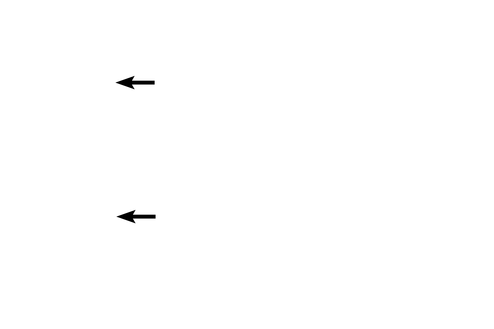 Posterior chamber > <p>The posterior chamber is a small, wedge-shaped ring bounded by the ciliary body, iris, periphery of the lens and the suspensory fibers of the lens.  The posterior chamber is filled with aqueous humor that originates in the ciliary body, flows through the posterior chamber into the anterior chamber and exits at the limbus via the trabecular meshwork and the canal of Schlemm.</p>
