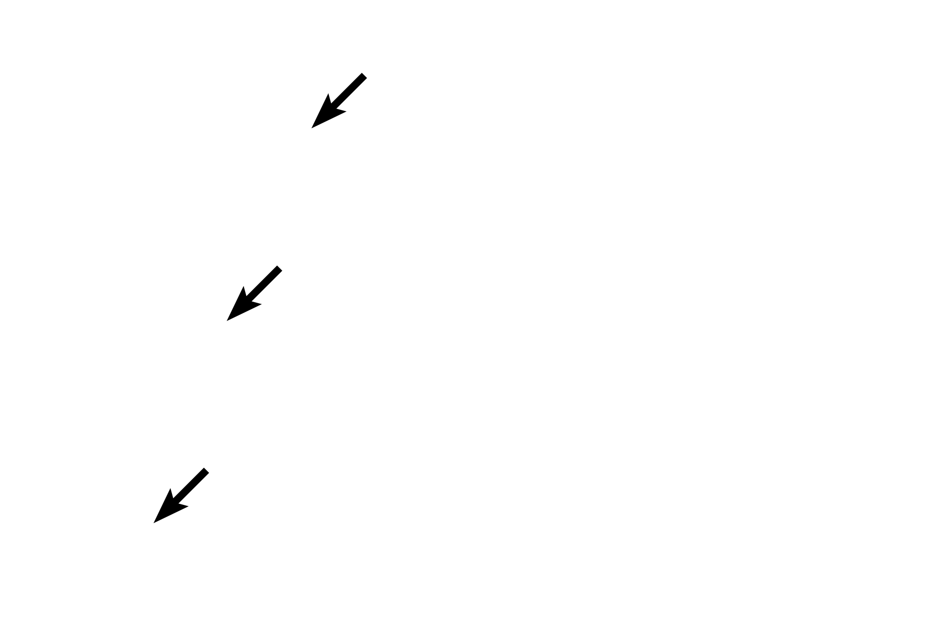 Bowman's membrane > <p>Bowman’s membrane, a specialized layer of the corneal stroma, underlies the epithelium.  This layer is composed of randomly arranged collagen fibrils.</p>
