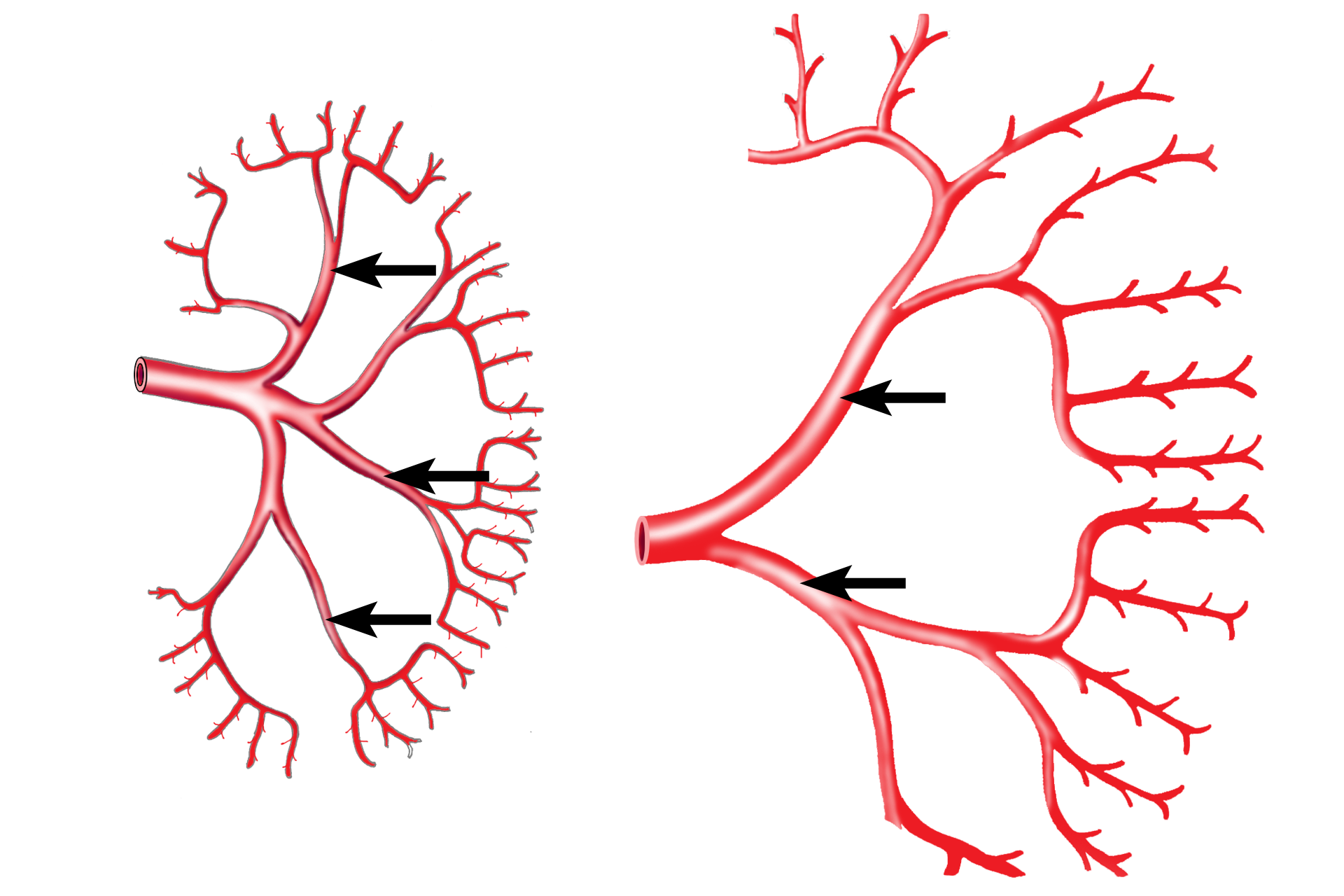  - Interlobar artery <p>When the renal artery enters the kidney, it branches into interlobar arteries, which travel between the pyramids through the renal columns. These arteries branch laterally to form the arcuate vessels that mark the boundary between cortex and medulla. Interlobular arteries leave the arcuates to enter the convoluted portions of the cortex.</p>
