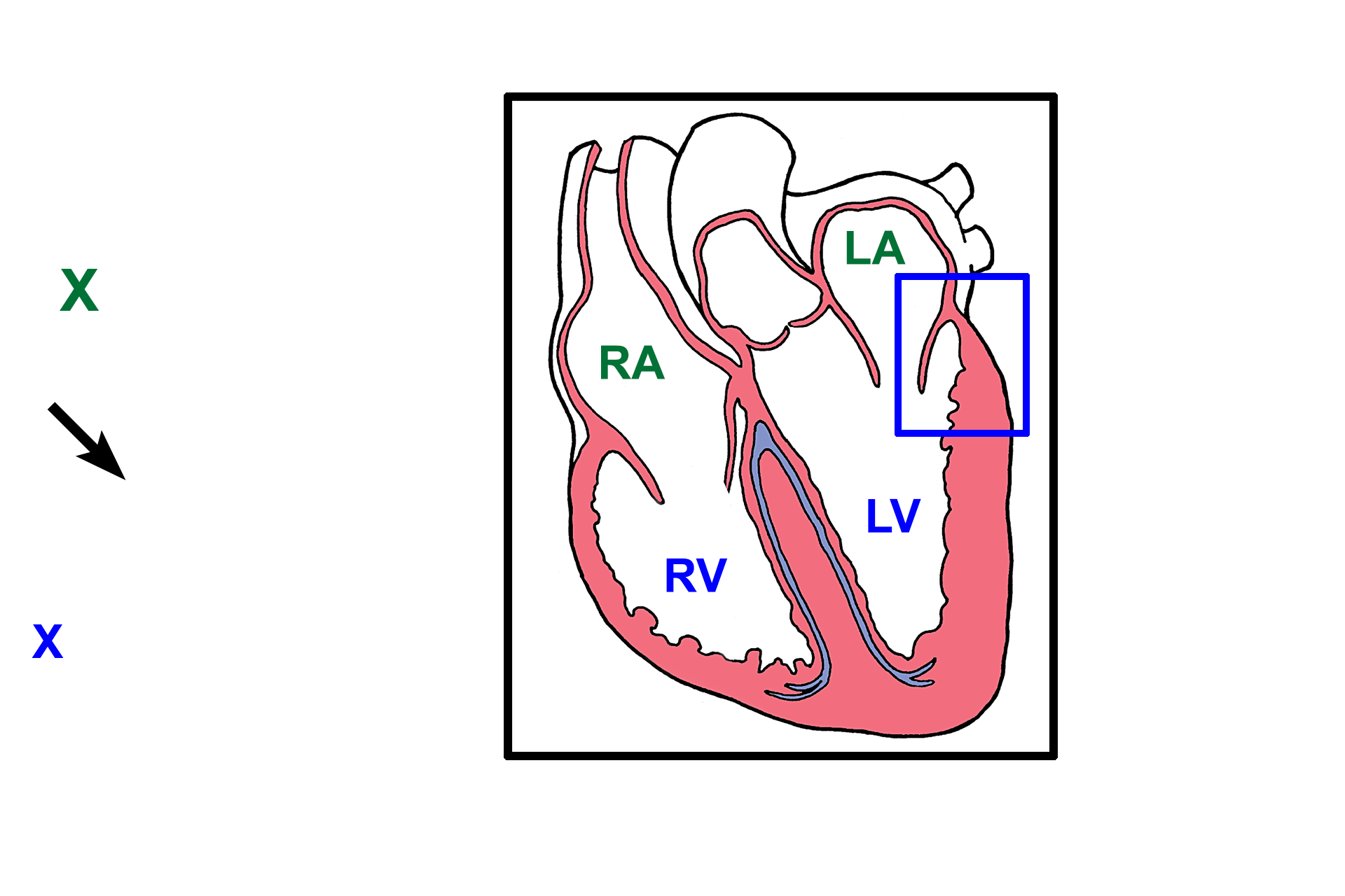 Heart components > <p>This section of the heart was taken from an area similar to that outlined by the blue rectangle in the illustration.  The left atrium (green X) is the upper chamber; the left ventricle (blue X) is the lower chamber; a flap of the atrioventricular valve (arrow) separates the two chambers.</p>
