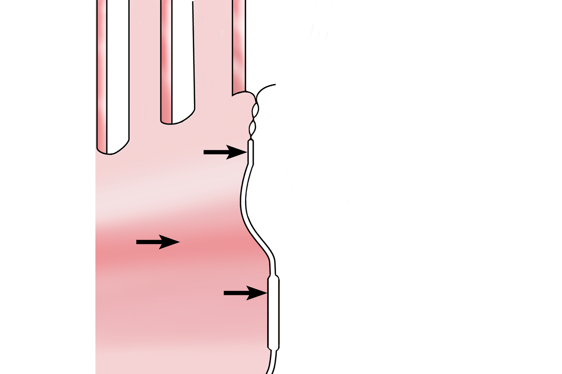Illustration > <p>In this illustration, most of the cell on the left side of the junctional complex has been removed, leaving only a view of the inner surface of its plasma membrane (arrows) and microvilli. The complexity, composition and extent of the components of the junctional complex will be illustrated using this figure as a foundation.</p>
