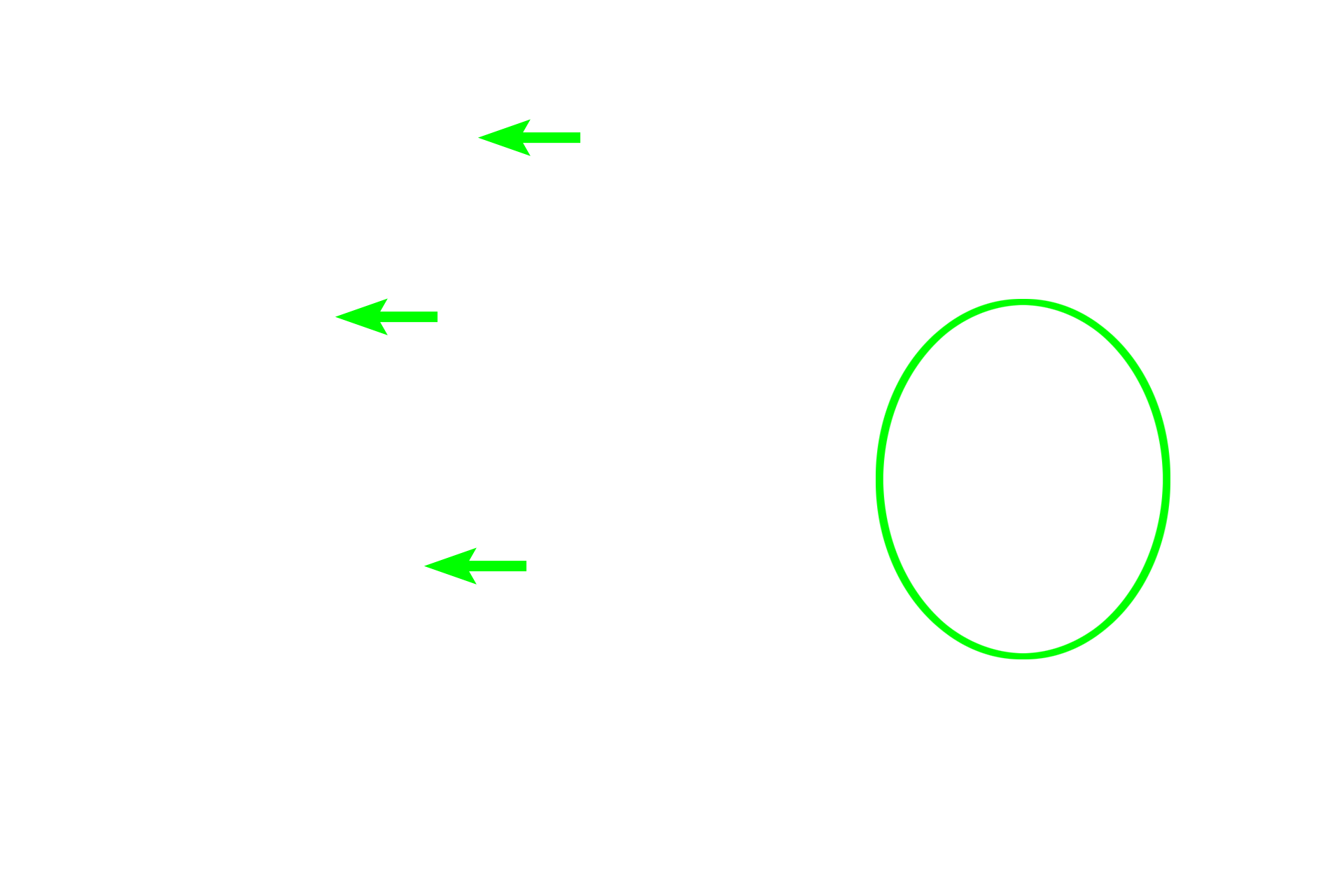 Leydig (interstitial) cells <p>Leydig (interstitial) cells constitute the endocrine portion of the testis.  They produce the steroid hormone, testosterone.  Steroid-secreting cells commonly have vacuoles in their cytoplasm, resulting from extraction of the lipid precursor molecules used in steroid synthesis. Blood vessels and lymphatics are abundant in the interstitium surrounding these cells. 1000x</p>
