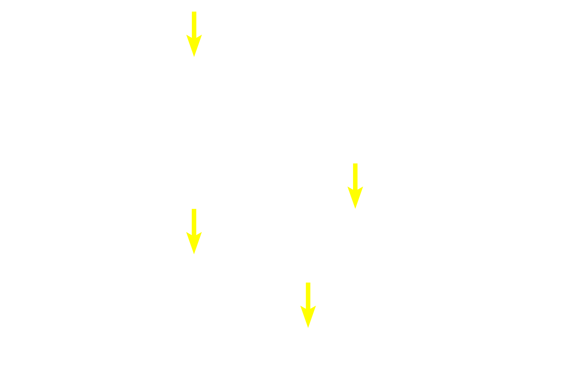 Spermatids (late) <p>Spermatogenesis has four phases: spermatocytogenesis (mitotic division of spermatogonia to primary spermatocytes); meiosis (a two-step division of primary spermatocytes to secondary spermatocytes to spermatids); spermiogenesis (cytodifferentiation of spermatids into mature spermatozoa); and spermiation (the release of sperm from Sertoli cells). 600X</p>
