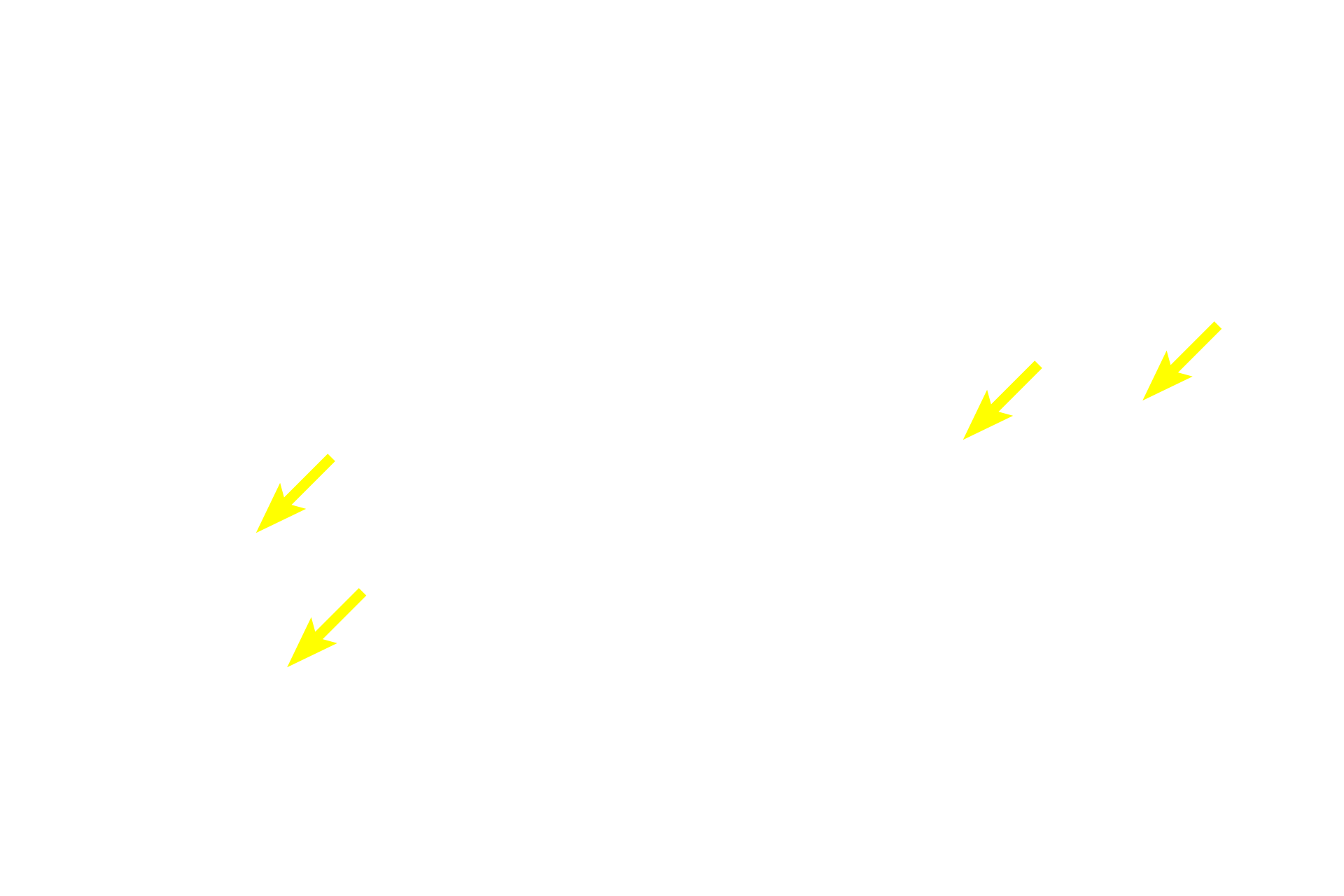 Sertoli cells <p>Spermatogenesis has four phases: spermatocytogenesis (mitotic division of spermatogonia to primary spermatocytes); meiosis (a two-step division of primary spermatocytes to secondary spermatocytes to spermatids); spermiogenesis (cytodifferentiation of spermatids into mature spermatozoa); and spermiation (the release of sperm from Sertoli cells). 600X</p>
