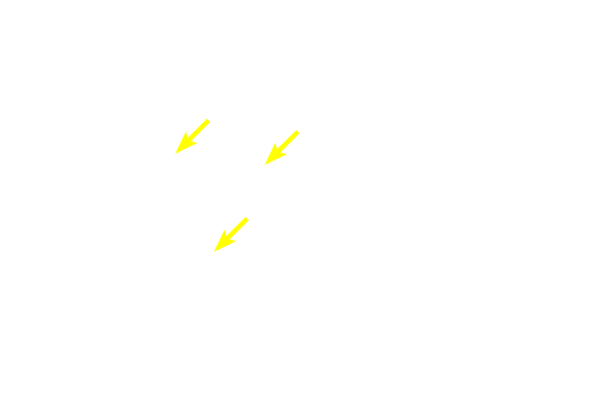 Late spermatids <p>Primary spermatocytes, the largest cells in the spermatogenic lineage, form from mitotic division of spermatogonia in the basal compartment. Primaries migrate through the blood-testis barrier and enter a prolonged period of prophase of meiosis I. Primary spermatocytes complete meiosis I, the reductional phase, to produce haploid secondary spermatocytes. 1000x</p>
