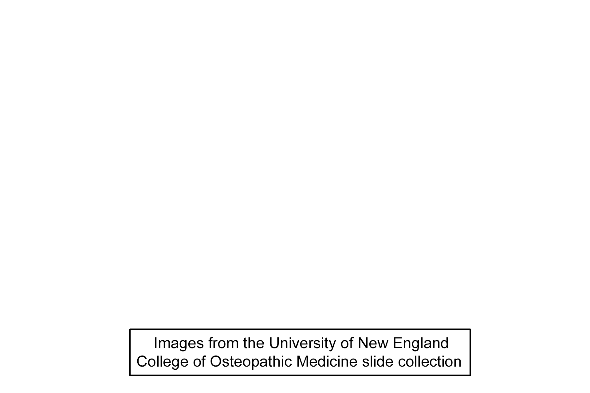 Image source > <p>Image taken of a slide from the University of New England College of Osteopathic Medicine slide collection.</p>

