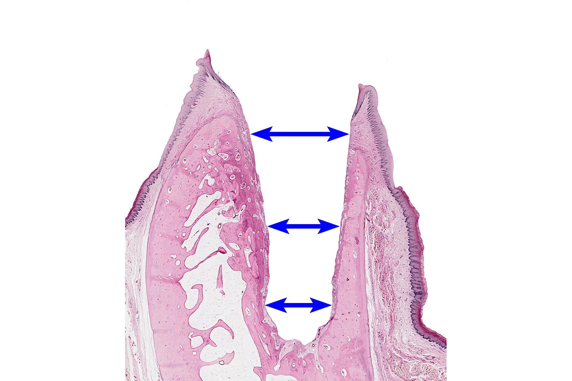 Dental alveolus > <p>The dental alveolus is a bony socket that holds the tooth.  Dental alveoli are located in the maxilla and mandible.  All alveolar bone is differentiated from ectomesenchymal stem cells of the dental follicle.  This image was created by digitally removing all the tooth tissues.</p>
