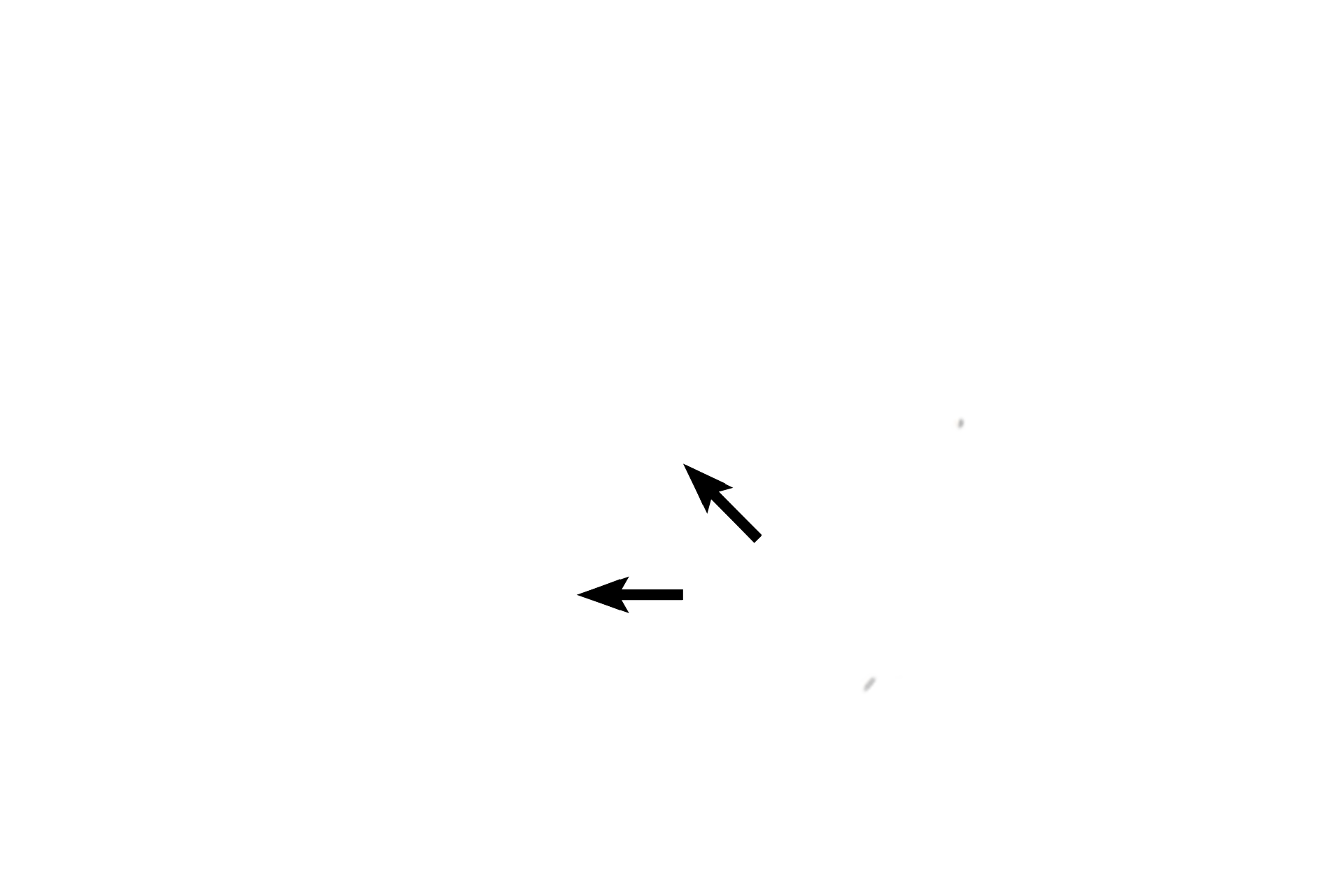 - Tympanic membrane <p>The auricle, or pinna (oval), with its framework of elastic cartilage, aids in accumulating sound waves. The external auditory meatus (arrows) is an S-shaped canal that terminates in the tympanic membrane (eardrum), separating the outer from the middle ear. Vibration of the tympanic membrane transmits sound vibrations to the ear ossicles.</p>