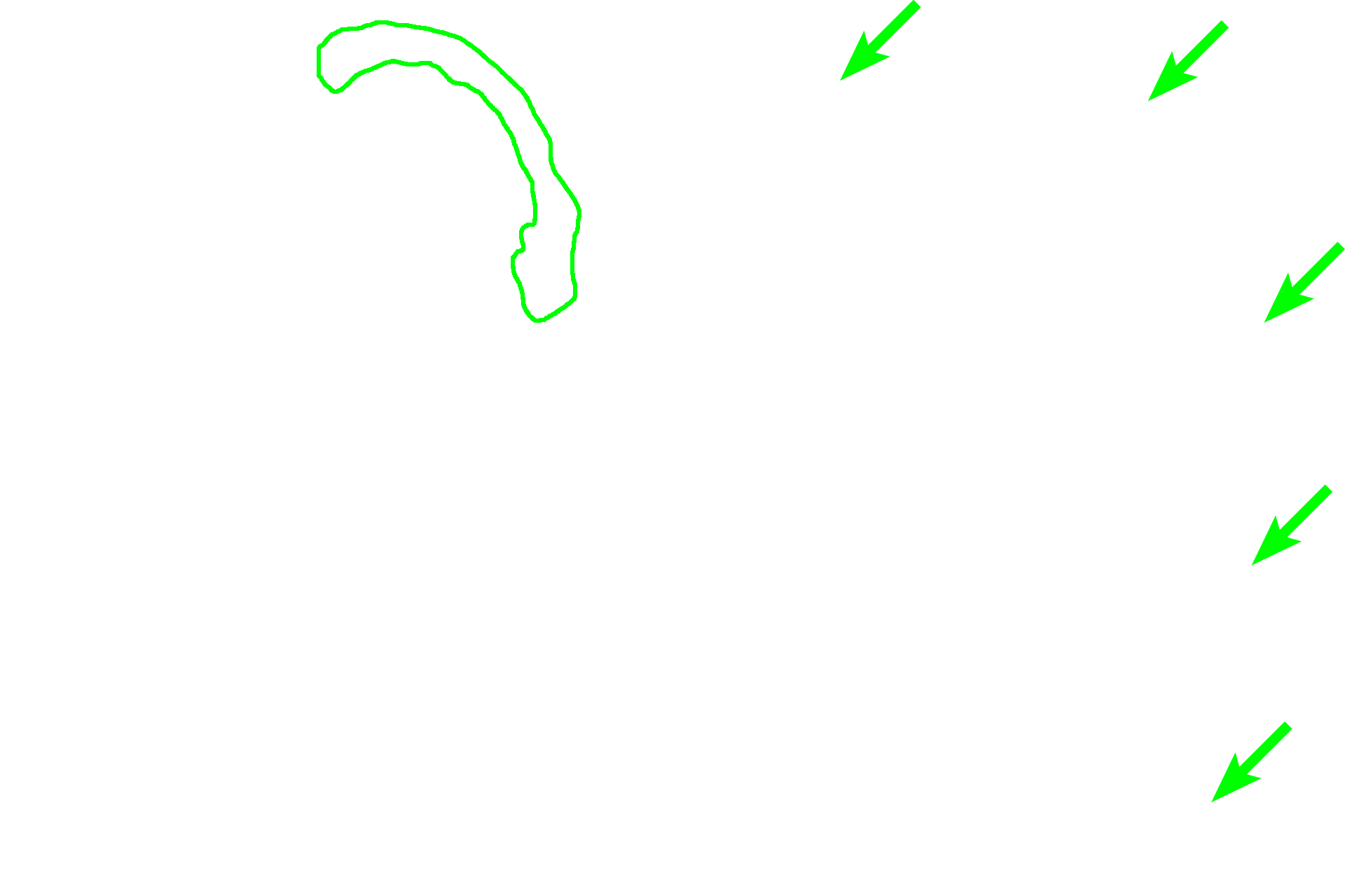 Peyer’s patch <p>Lymphoid nodules also occur in aggregates, such as Peyer’s patches in the small intestine. A single Peyer’s patch contains clusters of nodules surrounded by diffuse lymphoid tissue. Because Peyer’s patches are located in the lamina propria of the mucosa, they are part of MALT and filter tissue fluid. Peyer’s patches are most numerous in the ileum, seen here. An area similar to that outlined in the rectangle is shown at higher magnification on the right.  Ileum 40x (l); 100x (r)</p>
