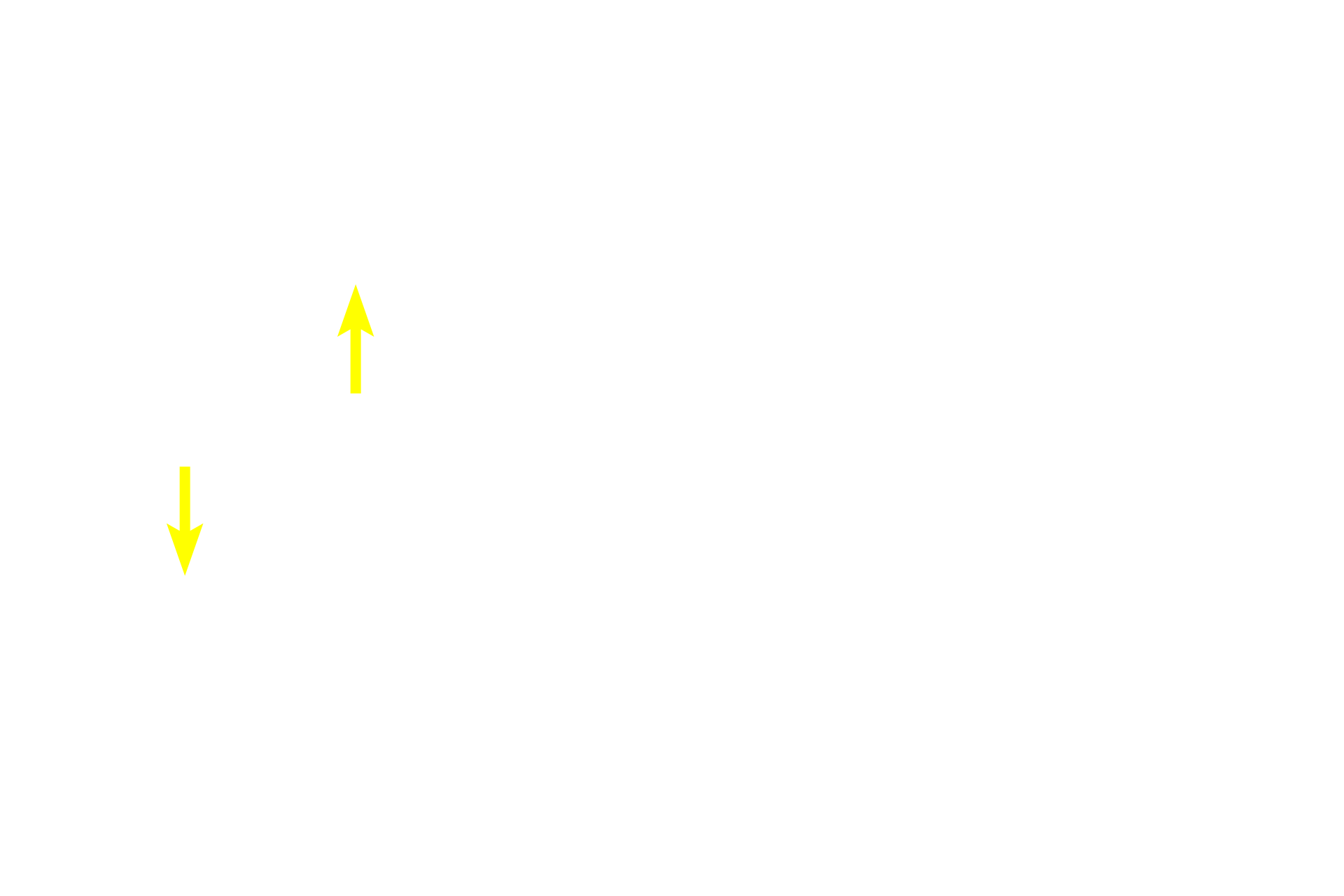 Migrating lymphocytes <p>The structure of high endothelial venules (HEVs) is shown to advantage in these thin plastic sections. The unique cuboidal-shaped endothelial cells facilitate the migration (diapedesis) of lymphocytes from the blood into the surrounding tissues. These venules are surrounded by diffuse lymphoid tissue. HEVs are present in all secondary lymphoid tissues and organs except the spleen. The two images on the left show cross sections; the image on the right is a longitudinal section. Lymph node, 600x (left panels); 400x (right panel) </p>
