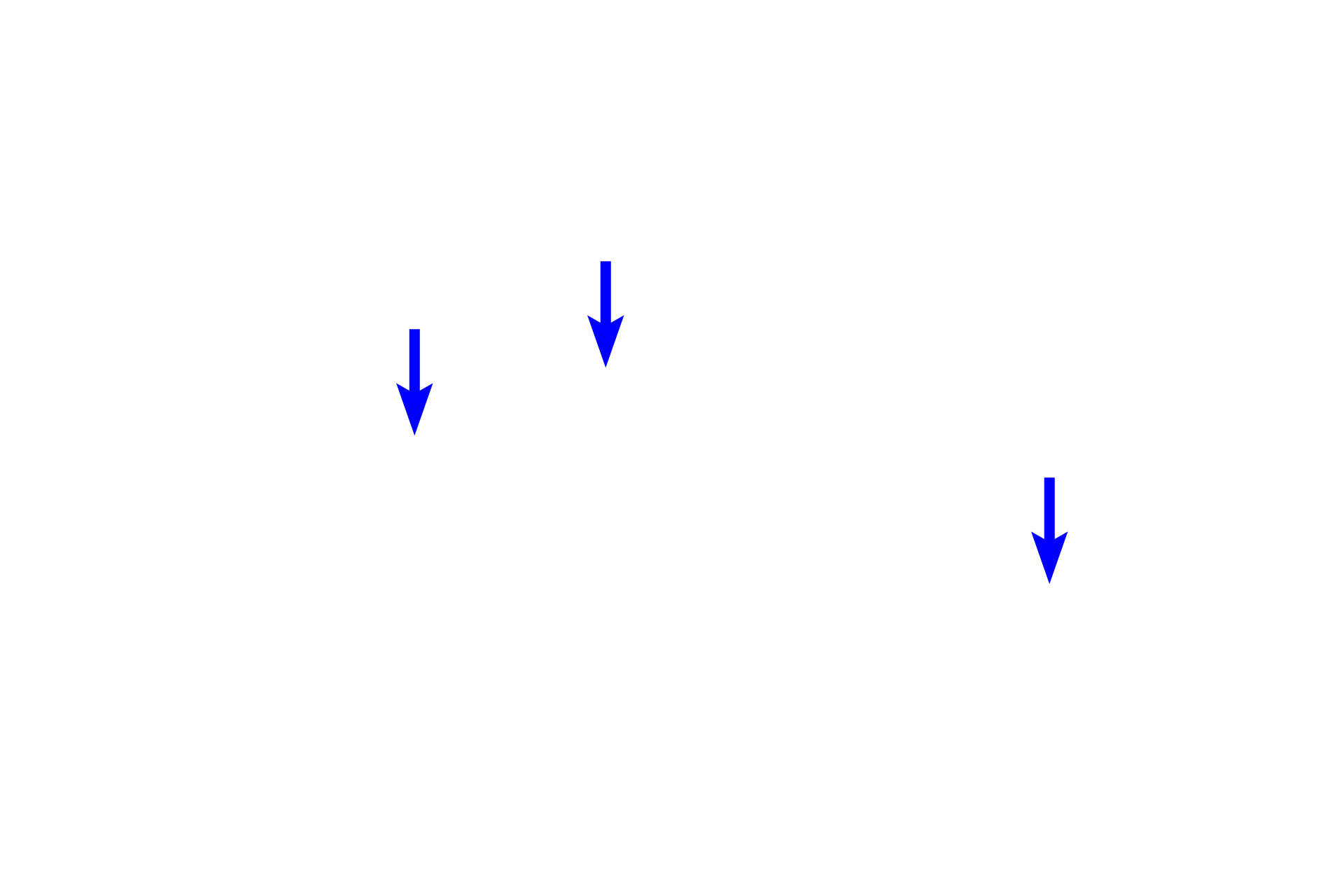 Muscularis mucosae <p>This larger secondary nodule shows an early germinal center surrounded by a mantle of small, unstimulated B lymphocytes. Here, the nodule has infiltrated the muscularis mucosae. Colon, 200x</p>
