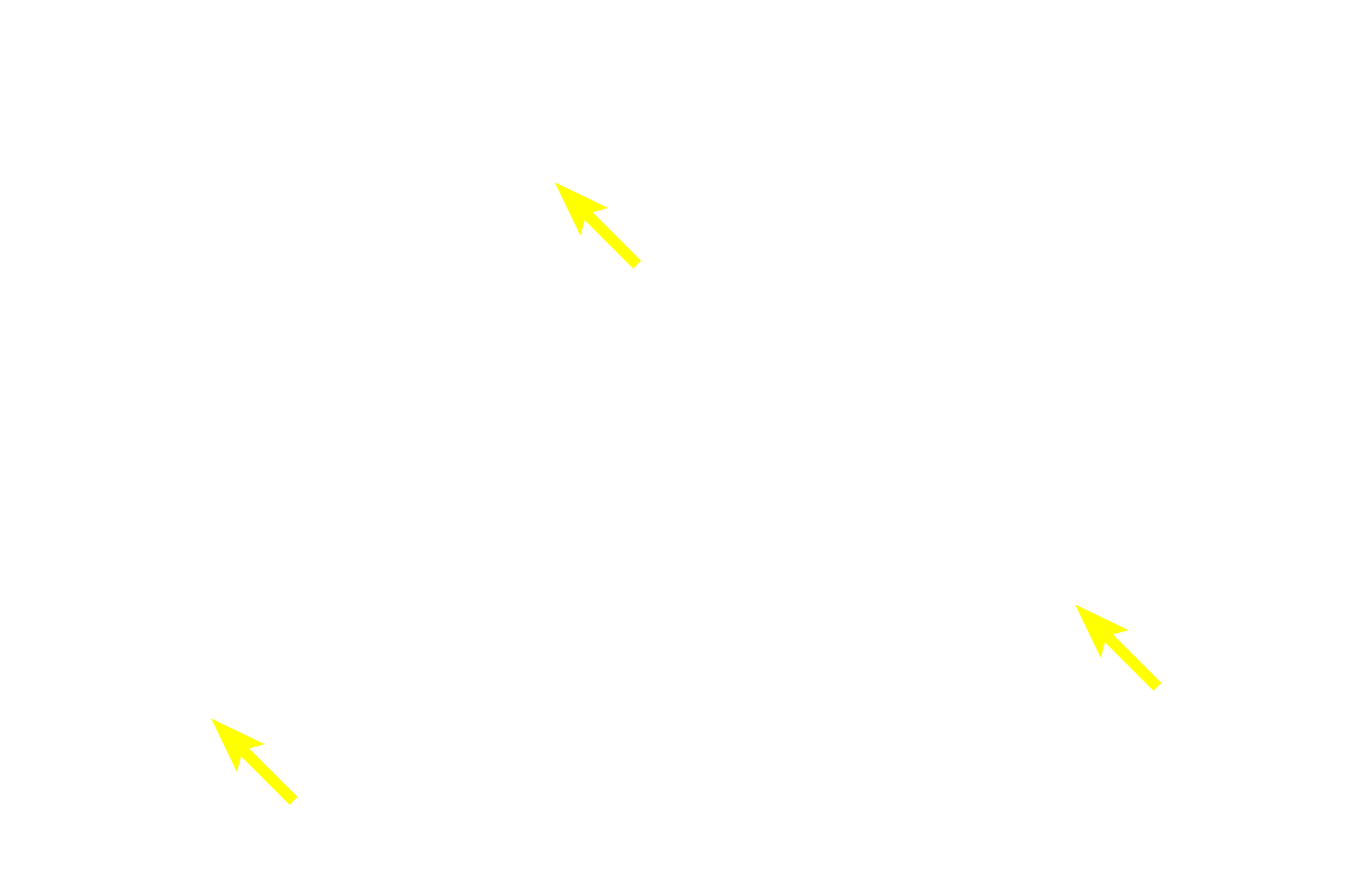 Immunoblasts <p>In the germinal center, B cells proliferate, altering their antibody-producing genes to diversify the humoral immune response. The cells then undergo a selection process whereby only those with the highest affinity antibodies survive to form immunoblasts. The remaining cells are eliminated through apoptosis and subsequent phagocytosis by macrophages. These macrophages are termed tingible body macrophages because the phagocytosed remnants of the B cells in their cytoplasm are readily stainable. 1000x  </p>
