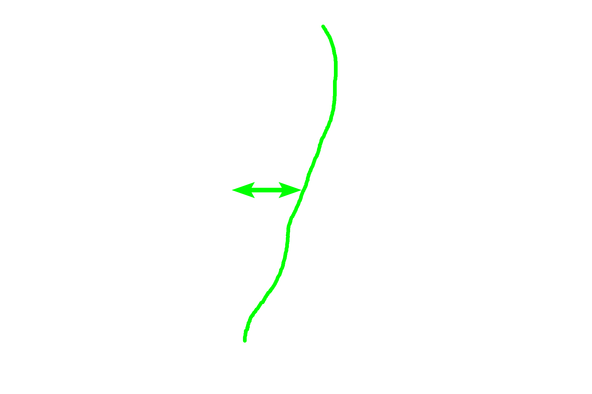  - Woven <p>The matrix of this spicule is in the process of being remodeled from woven into lamellar bone.</p>
