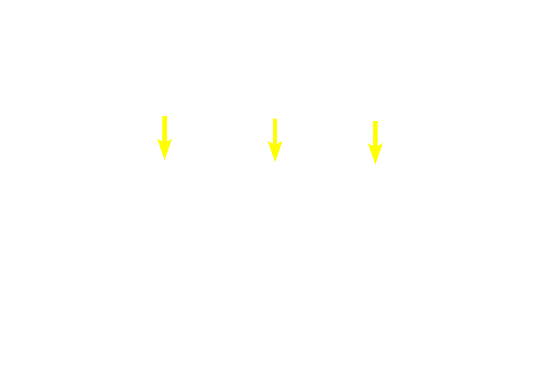 Trachealis muscle <p>The trachealis muscle is smooth muscle that spans the opening between the ends of each cartilage ring. Contraction of the muscle constricts the trachea thereby aiding in coughing by increasing airflow velocity. Its flexibility also facilitates swallowing by allowing the esophagus to expand. Mixed gland frequently accumulate next this muscle. 100x </p>
