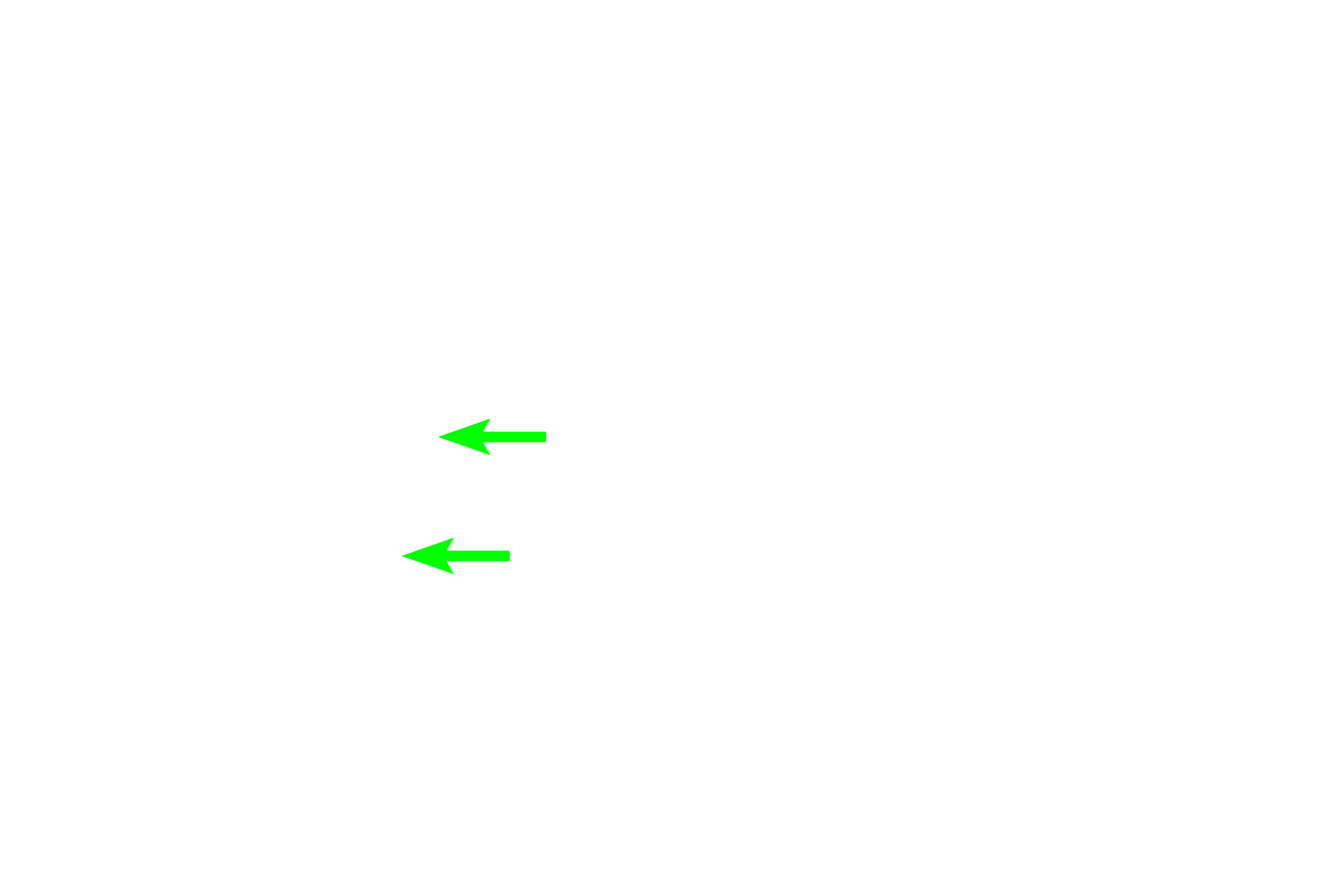 Bronchial artery <p>Two arterial systems, bronchial and pulmonary, supply blood to lung tissue. This image show a bronchial artery and vein in the wall of large bronchus. Bronchial arteries supply oxygenated blood to the tissues forming the walls of respiratory passageways. They originate as branches of the descending thoracic aorta and travel within the wall of the passageways. Pulmonary arteries, carrying deoxygenated blood, travel adjacent to respiratory passageways and supply alveolar capillaries where gas exchange occurs.  250x</p>
