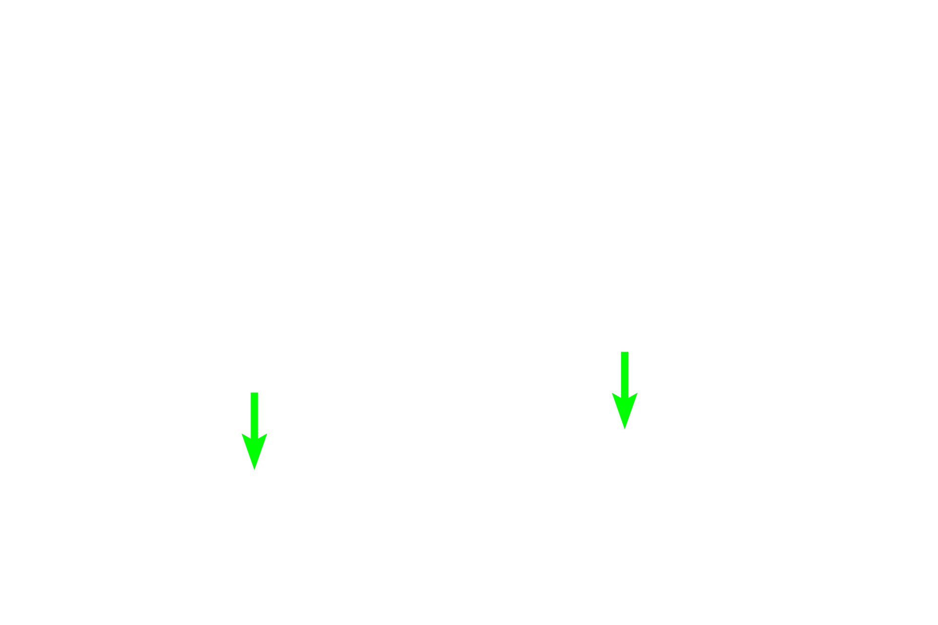  - Mixed glands <p>This smaller bronchus and its accompanying pulmonary artery are seen in cross section, surrounded by alveoli. The pulmonary artery lies outside the wall of the bronchus.  200x</p>
