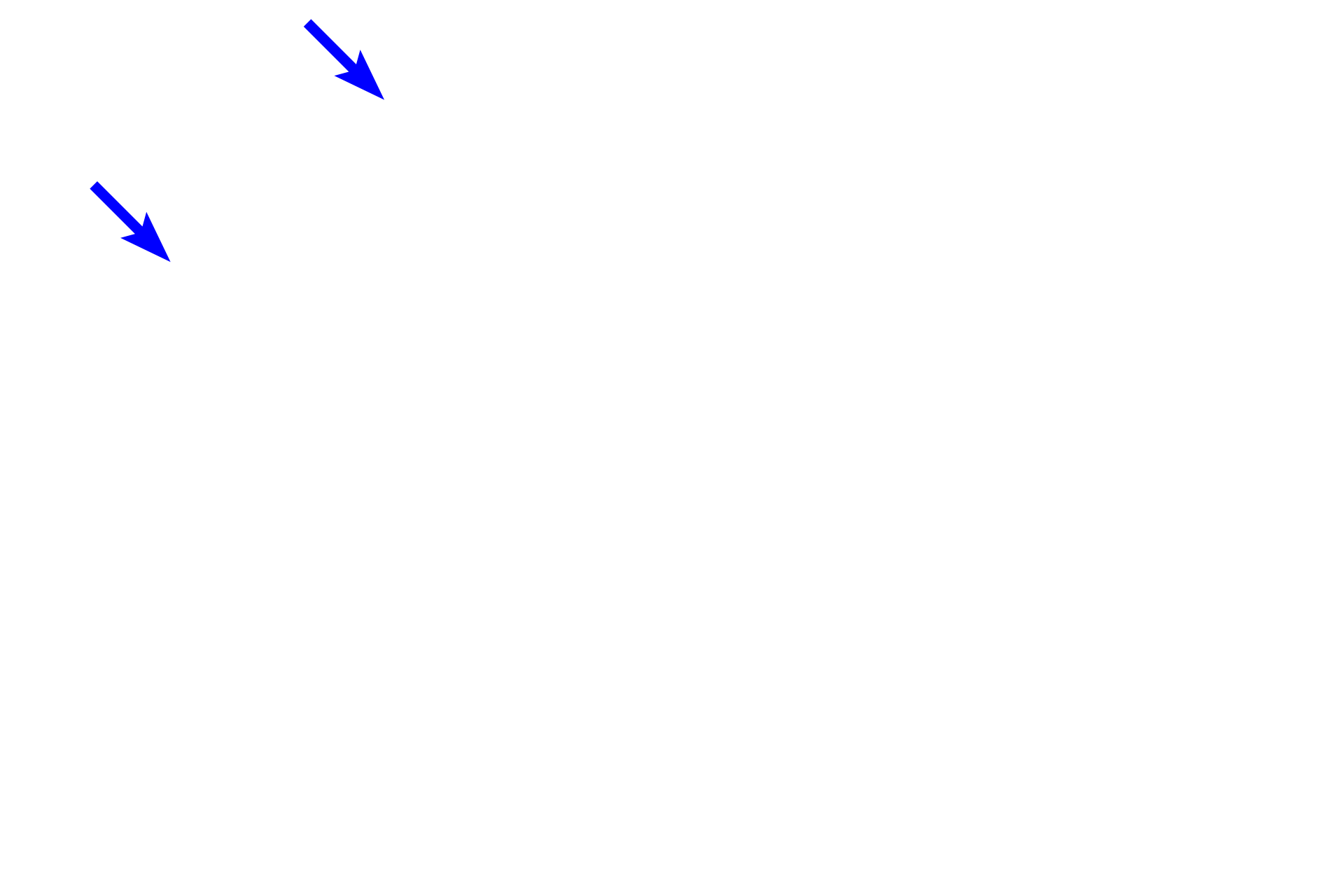 Visceral pleura <p>This longitudinal section of a large pulmonary vein will join others to form two main pulmonary veins that exit the lung at the hilum, accompanied by a primary bronchus and a pulmonary artery. Blood in pulmonary veins returns to the left atrium of the heart, joining the general systemic circulation. A portion of the pleura has detached from the surface of the lung.  40x</p>
