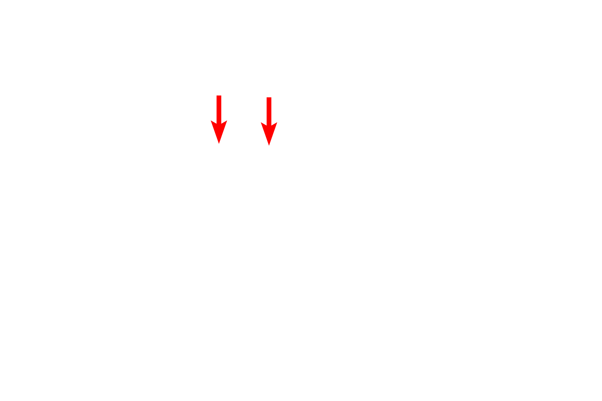 Alveolar lining: Type II cell > <p>Type II cells (septal cells or Type II pneumocytes) also line the alveolar space although they cover far less surface area than do the Type I cells. These cuboidal cells can be identified by their frothy cytoplasm, indicative of the phospholipid surfactant they secrete. The thin surfactant layer reduces surface tension, thus aiding inflation of the alveoli during inspiration and preventing collapse.</p>
