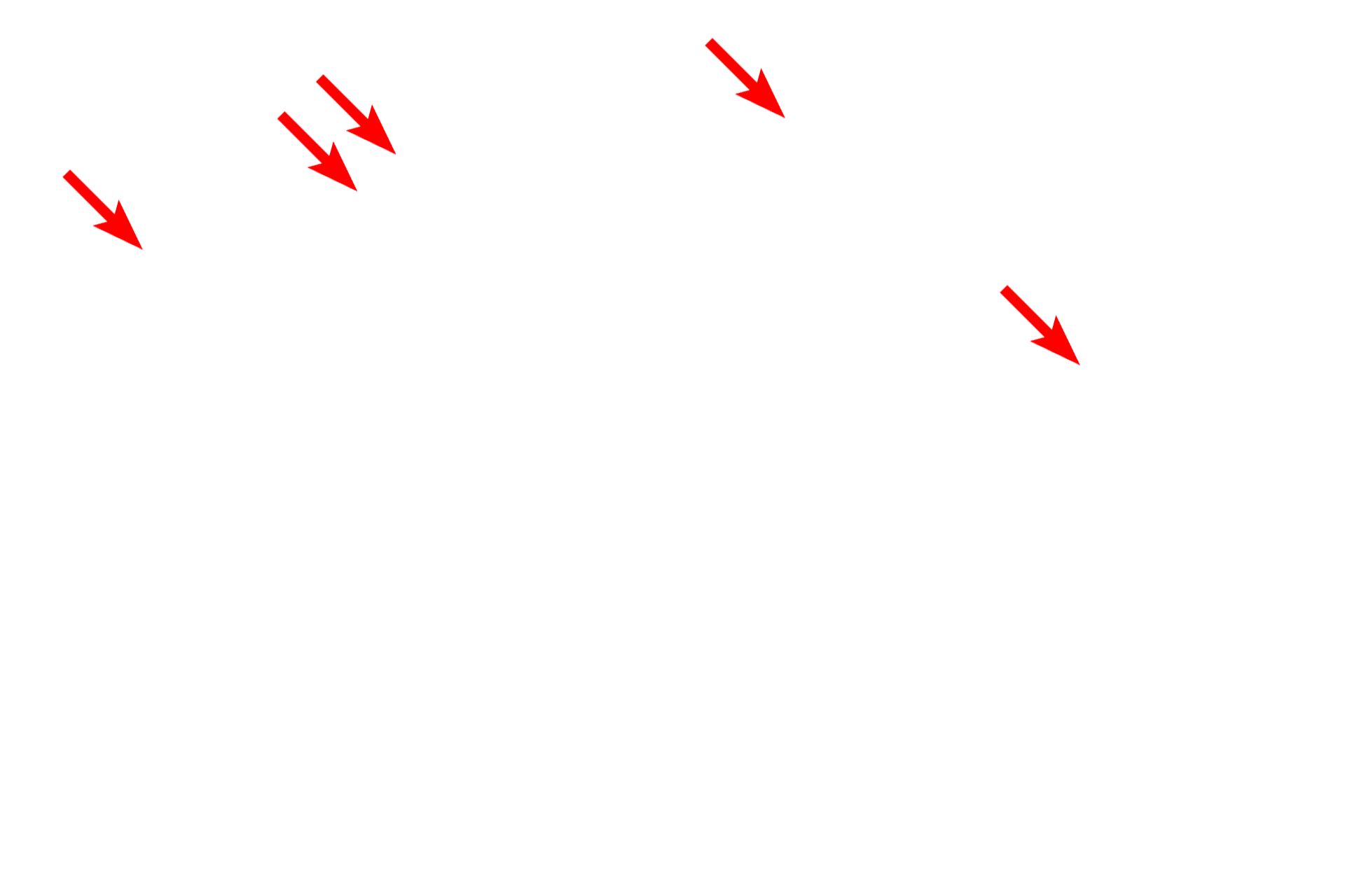  - Type I cells <p>This electron micrograph shows many of the components of the interalveolar septum illustrated in the previous illustration. Particularly thin type I cells line the entire alveolus and the bulging of capillaries into the air space is prominent. Surfactant is not preserved during fixation of lung tissue, and no septal cells nor macrophages are present in this image. 4000x</p>

