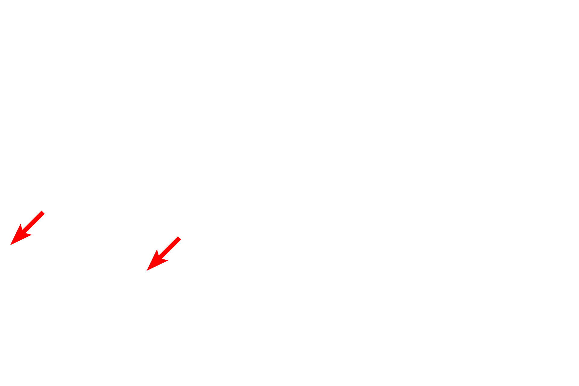  - Blood cells <p>This electron micrograph shows many of the components of the interalveolar septum illustrated in the previous illustration. Particularly thin type I cells line the entire alveolus and the bulging of capillaries into the air space is prominent. Surfactant is not preserved during fixation of lung tissue, and no septal cells nor macrophages are present in this image. 4000x</p>

