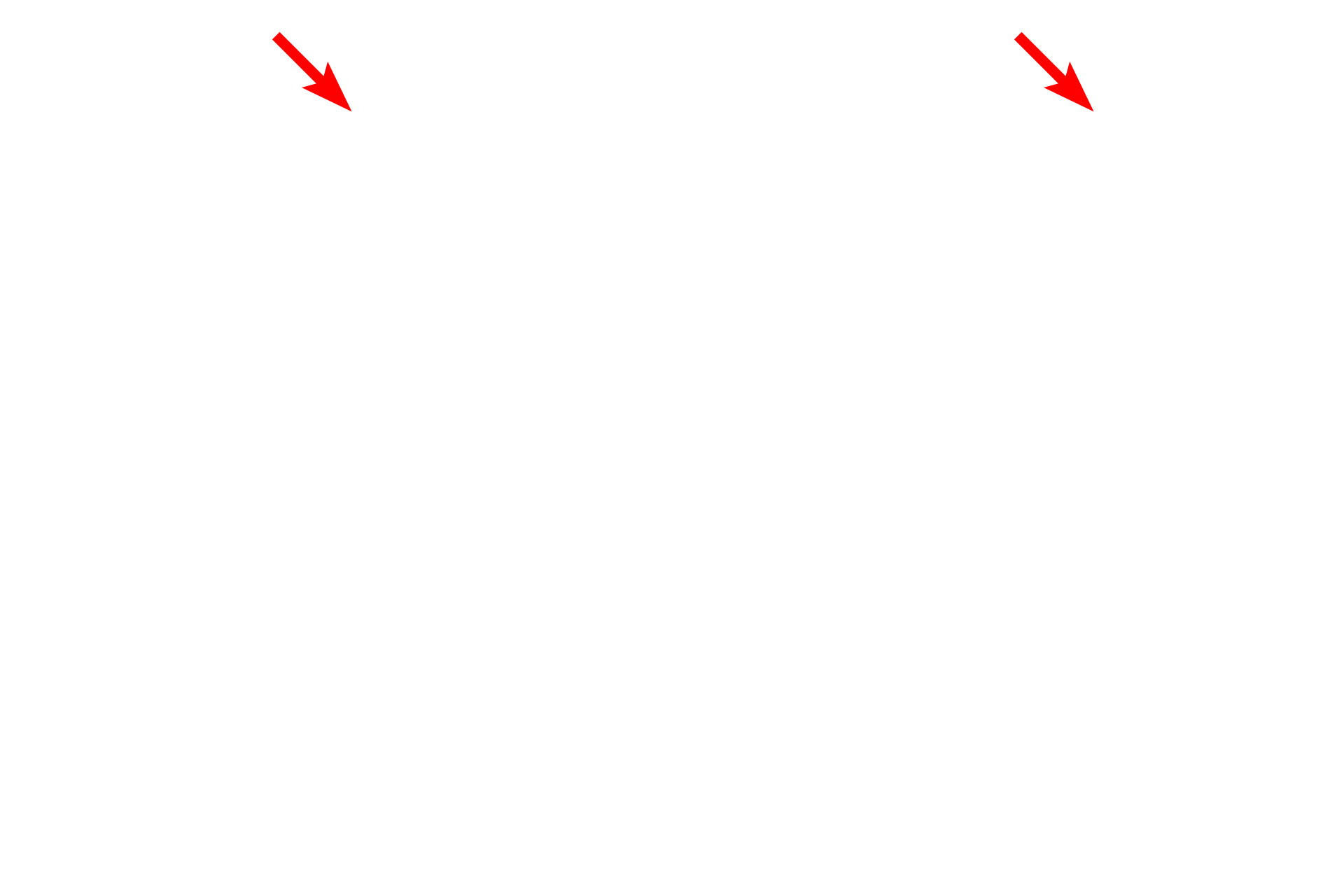 Smooth muscle knobs <p>This image shows another alveolus attached to an alveolar duct, as indicated by the presence of smooth muscle knobs. Note the large numbers of capillaries in the septum that bulge into the alveolar space. The alveolus is lined by a thin epithelium of Type I cells which, along with the endothelium of the capillaries, form the air-blood barrier.  Toluidine blue, 1000x</p>
