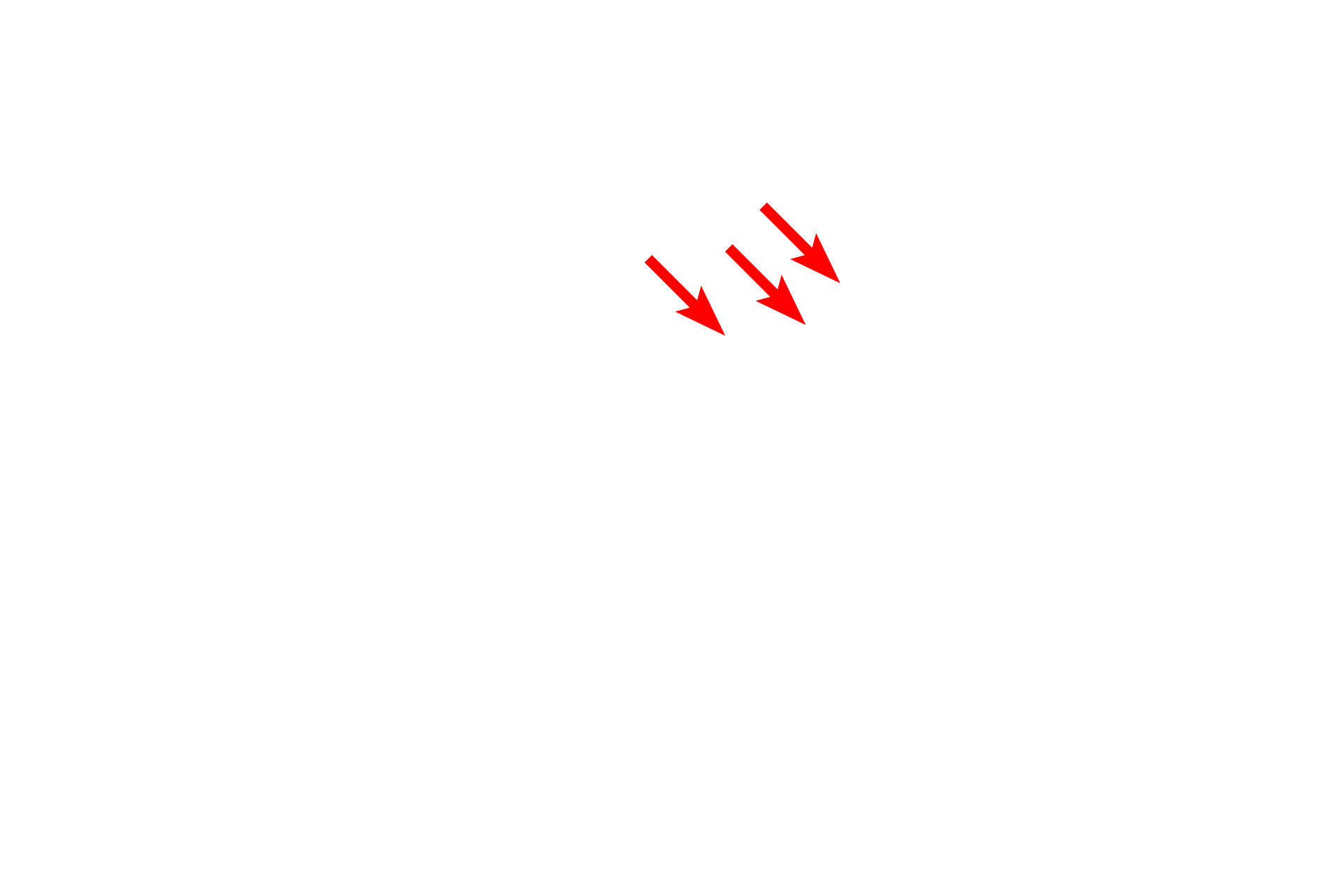  -- Secretory granules <p>By electron microscopy, the details of the interalveolar septum are more evident, particularly the cytology of a type II (septal) cell. Septal cells secrete surfactant, a mixture of phospholipids and protein. The secretory granules (vesicles) are often referred to as lamellar bodies, due to their lipid content. One granule in the process of exocytosis is visible. 4000x</p>
