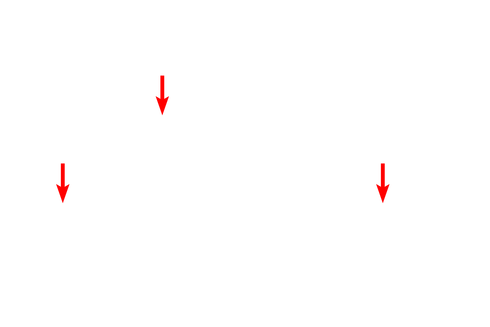  -- Endothelial cell nuclei <p>By electron microscopy, the details of the interalveolar septum are more evident, particularly the cytology of a type II (septal) cell. Septal cells secrete surfactant, a mixture of phospholipids and protein. The secretory granules (vesicles) are often referred to as lamellar bodies, due to their lipid content. One granule in the process of exocytosis is visible. 4000x</p>
