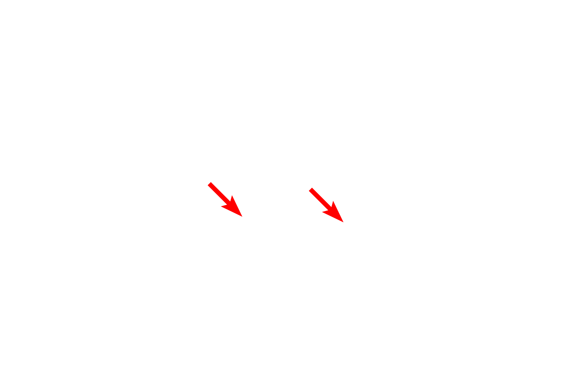  - Fibroblasts <p>By electron microscopy, the details of the interalveolar septum are more evident, particularly the cytology of a type II (septal) cell. Septal cells secrete surfactant, a mixture of phospholipids and protein. The secretory granules (vesicles) are often referred to as lamellar bodies, due to their lipid content. One granule in the process of exocytosis is visible. 4000x</p>
