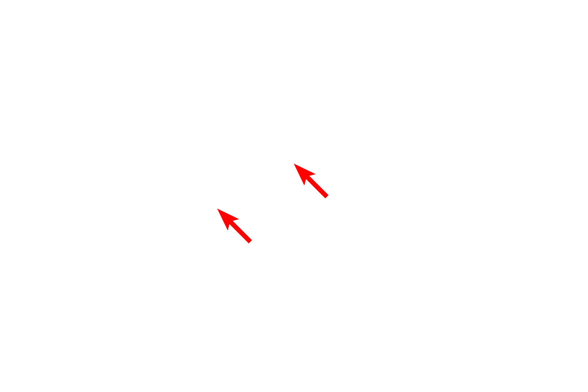 Alveolar macrophages >  <p>Alveolar macrophages are derived from monocytes and normally phagocytose foreign debris that reaches the lungs. During congestive heart failure, they phagocytose extravasated blood accumulating in alveoli and are then called “heart failure” cells.</p>
