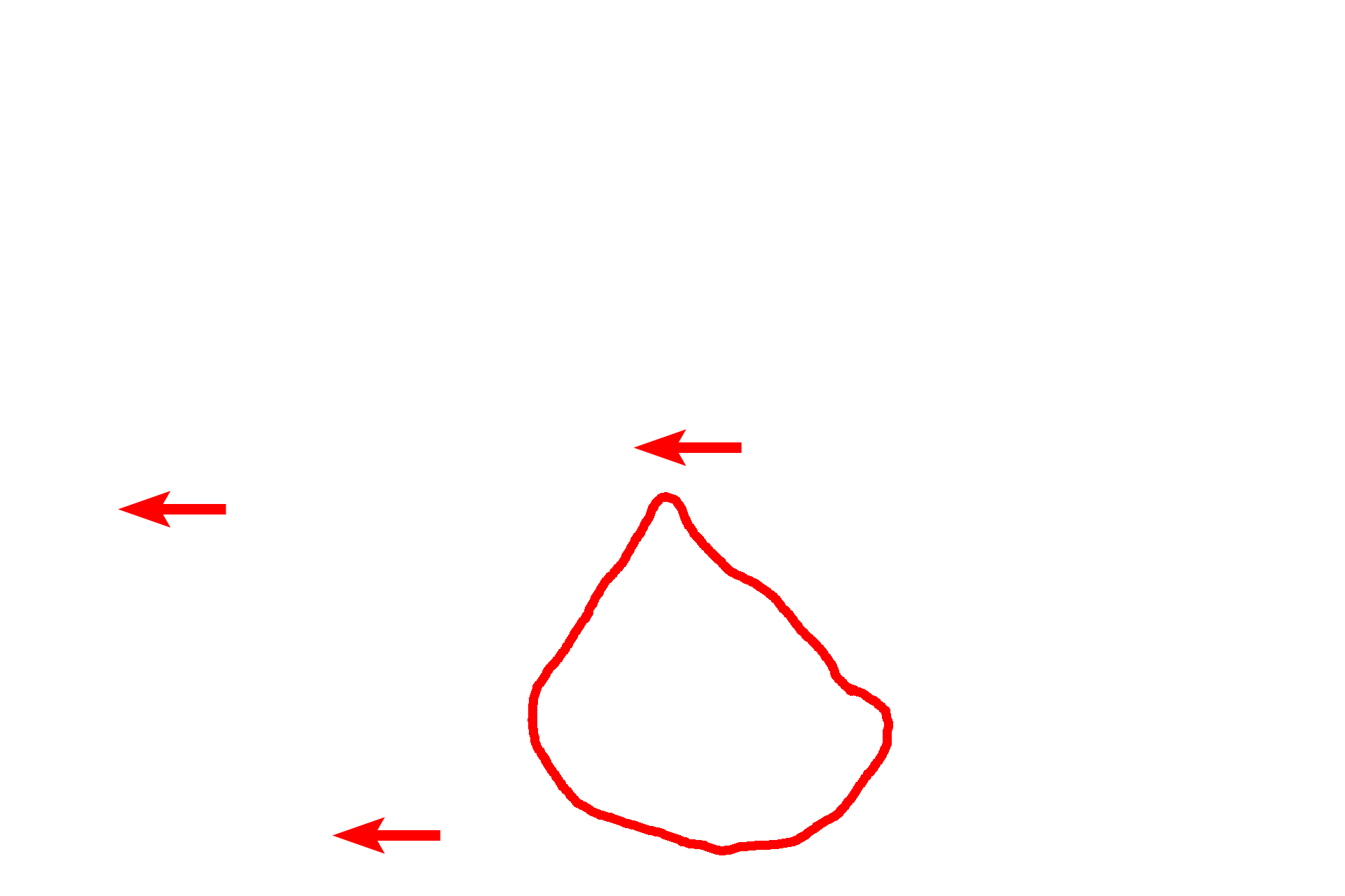  - Type II cells <p>An alveolar macrophage is seen lying in the lumen of an alveolus, adjacent to the interalveolar septum. Abundant phagocytosed material is visible in its cytoplasm. The attenuated cytoplasm of the type I cells lines the interalveolar septum with its numerous capillaries. Septal cells can be identified by the vacuolated secretory granules in their cytoplasm. These granules contain lipoprotein that serves as a surfactant.  5000x</p>
