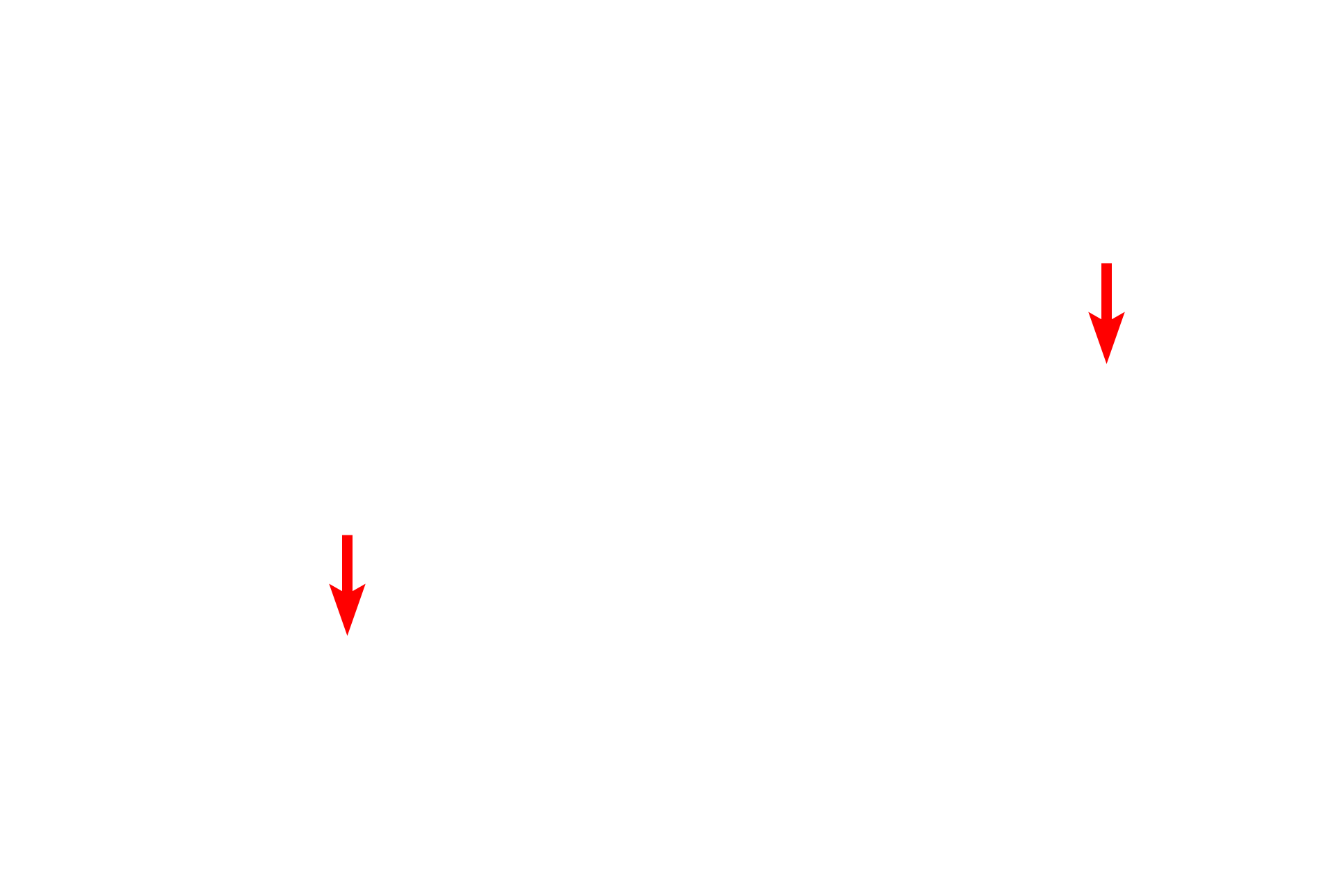  -- Endothelial nuclei <p>An alveolar macrophage is seen lying in the lumen of an alveolus, adjacent to the interalveolar septum. Abundant phagocytosed material is visible in its cytoplasm. The attenuated cytoplasm of the type I cells lines the interalveolar septum with its numerous capillaries. Septal cells can be identified by the vacuolated secretory granules in their cytoplasm. These granules contain lipoprotein that serves as a surfactant.  5000x</p>
