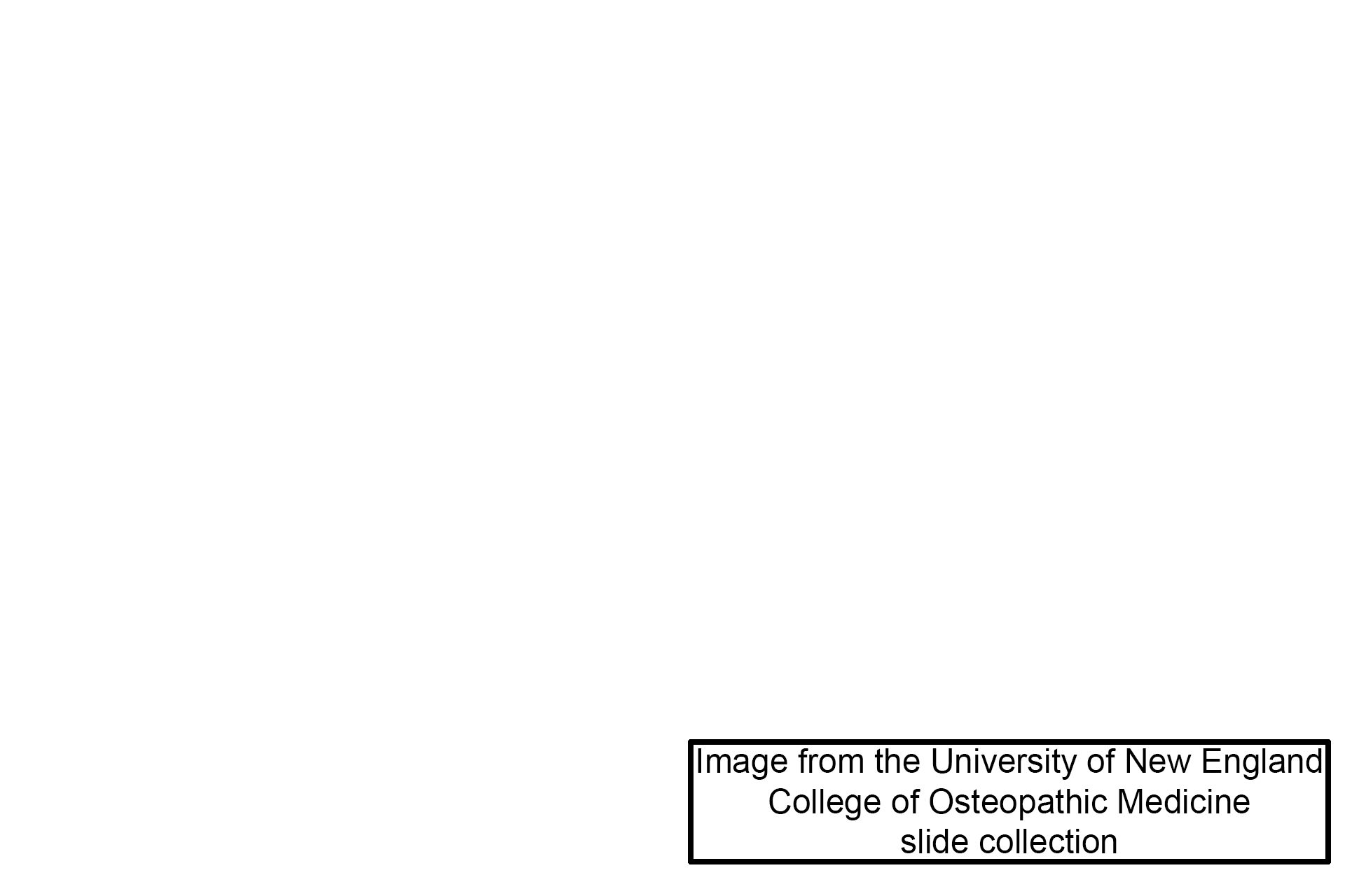 Image source > <p>This image was taken of a slide in the University of New England College of Osteopathic Medicine collection.</p>
