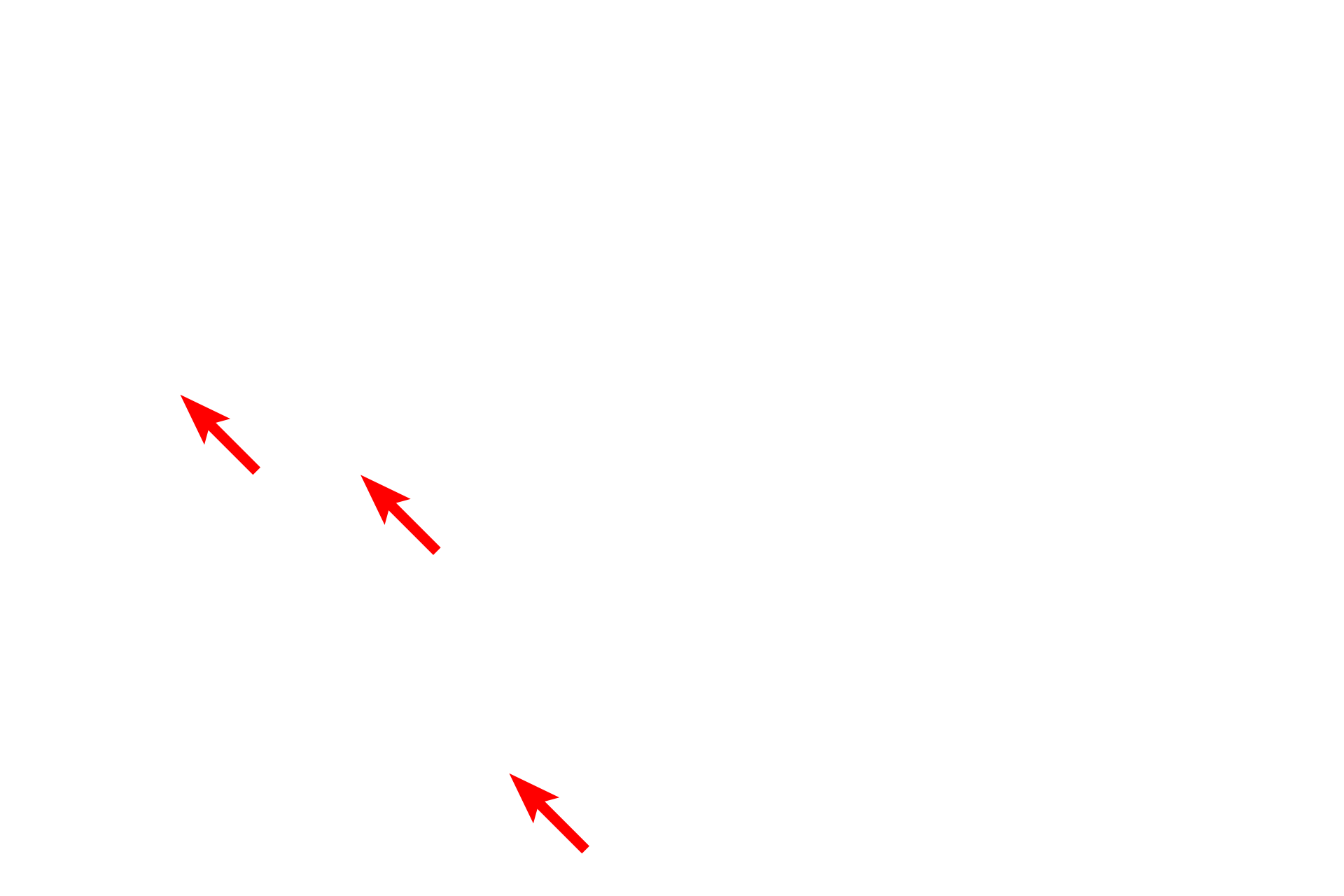 Nuclei <p>Osmium tetroxide is both a stain and a fixative for lipid, a chemical reaction that produces a brown color visible by light microscopy. Lipid can be distributed as small, cytoplasmic droplets (left) or a single large droplet that nearly fills the cell (right). This latter distribution occurs in adipocytes, which are specialized fat storage cells. The use of osmium to preserve lipids for electron microscopy, provides electron density to tissues. Toluidine blue stain, 1000x, 1000x </p>
