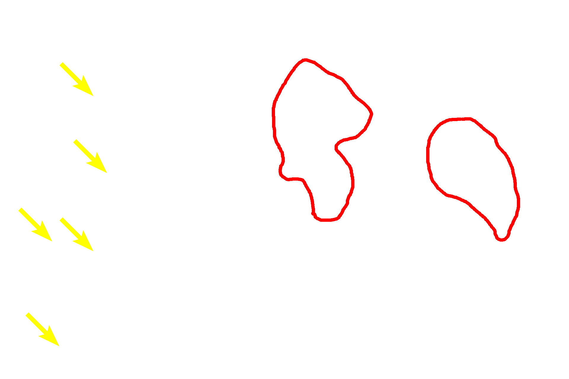 Glycogen aggregates <p>These images compare the appearance of glycogen in hepatocytes by light microscopy (left, PAS stain) and electron microscopy (right). Individual glycogen granules, which measure 15 to 40 nm in diameter, are too small to be resolved by light microscopy. However, aggregates of these granules, which measure up to 300 nm in diameter, can be visualized. By electron microscopy, aggregates and their individual granules are clearly evident.  1000x (l); 7500x (r)</p>
