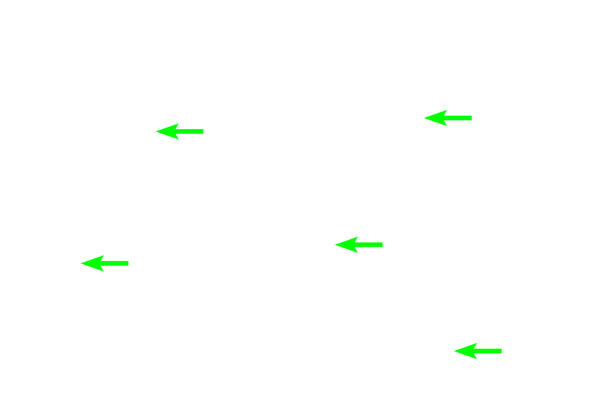  - Matrix <p>A region of developing spongy bone shows spicules composed of woven bone surrounded by mesenchymal connective tissue. Osteocytes within the spicules are randomly arranged and the matrix appears amorphous, not composed of lamellae. The matrix of these spicules will gradually be remodeled into regularly arranged, flattened lamellae with osteocytes orderly arranged between them.  400x</p>
